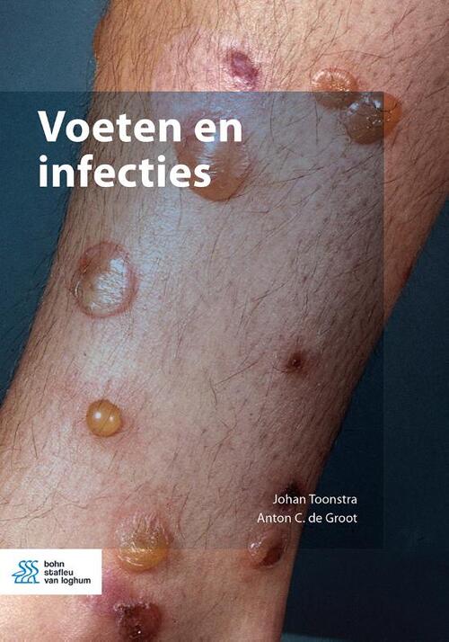 Voeten en infecties -  Anton de Groot, Johan Toonstra (ISBN: 9789036829168)