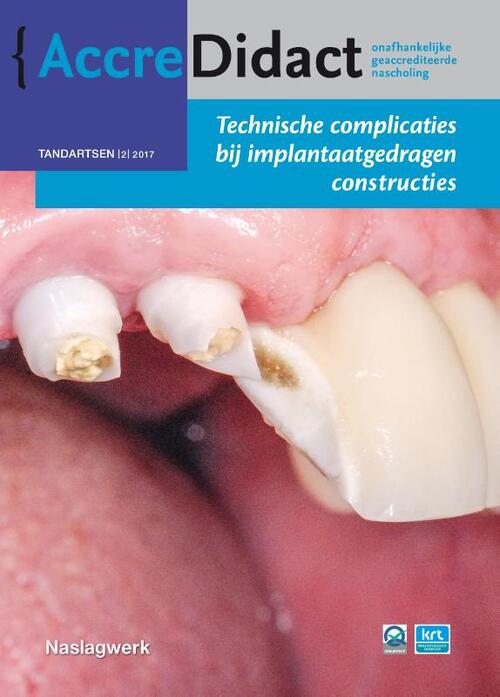 Technische complicaties bij implantaatgedragen constructies -  Gordon van der Avoort (ISBN: 9789089762498)