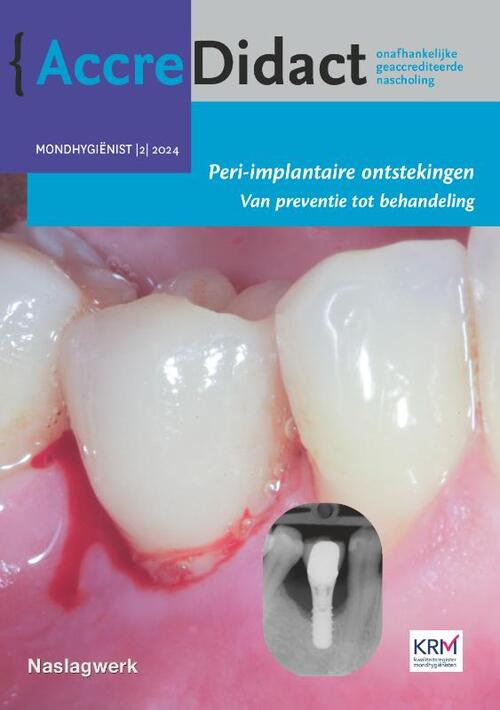 Peri-implantaire ontstekingen -  Erik Blom (ISBN: 9789089765338)