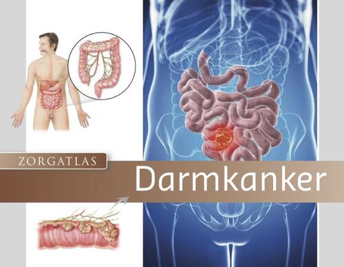 Zorgatlas Darmkanker -  Dianne Backelandt (ISBN: 9789491984471)